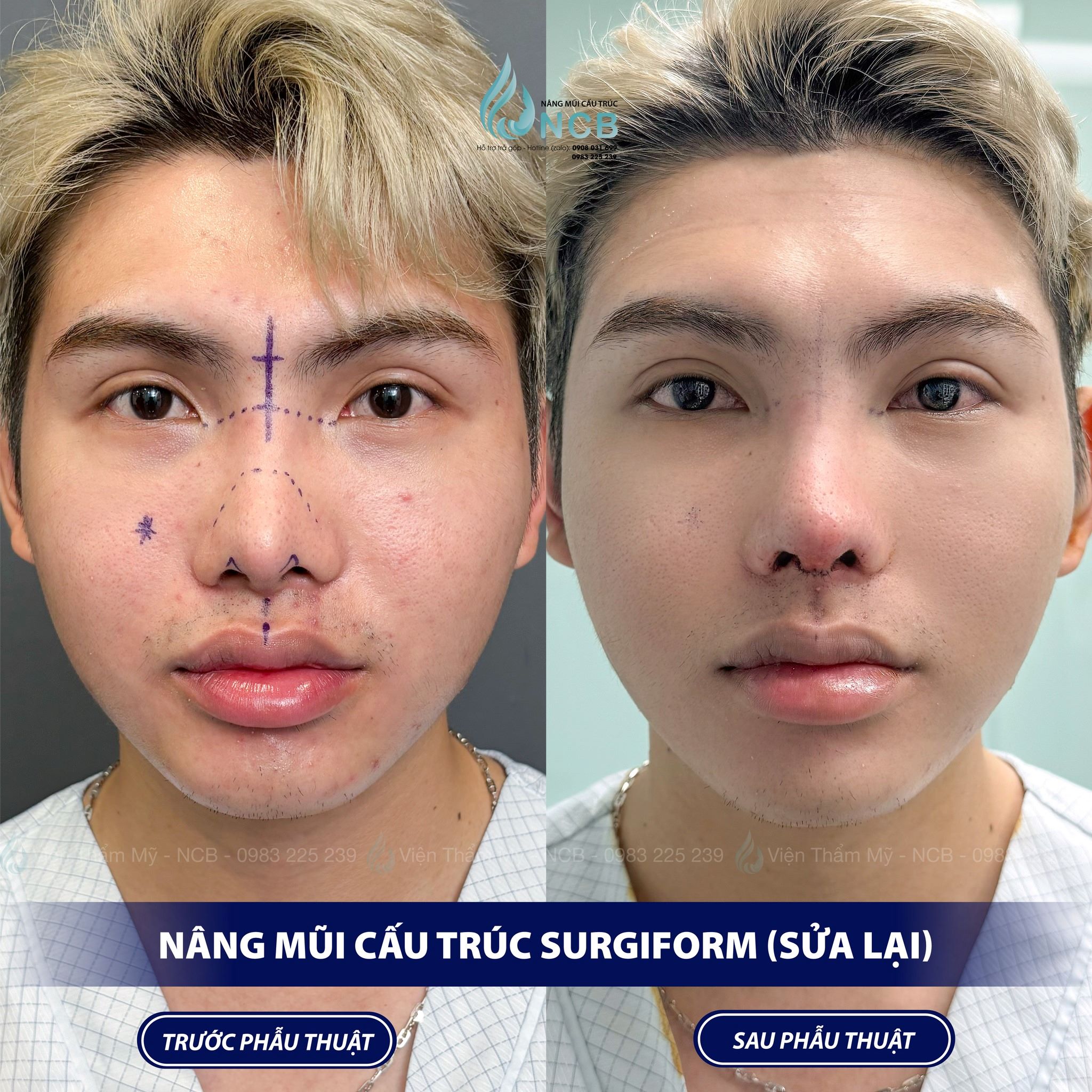 nghĩa một lít son nâng mũi