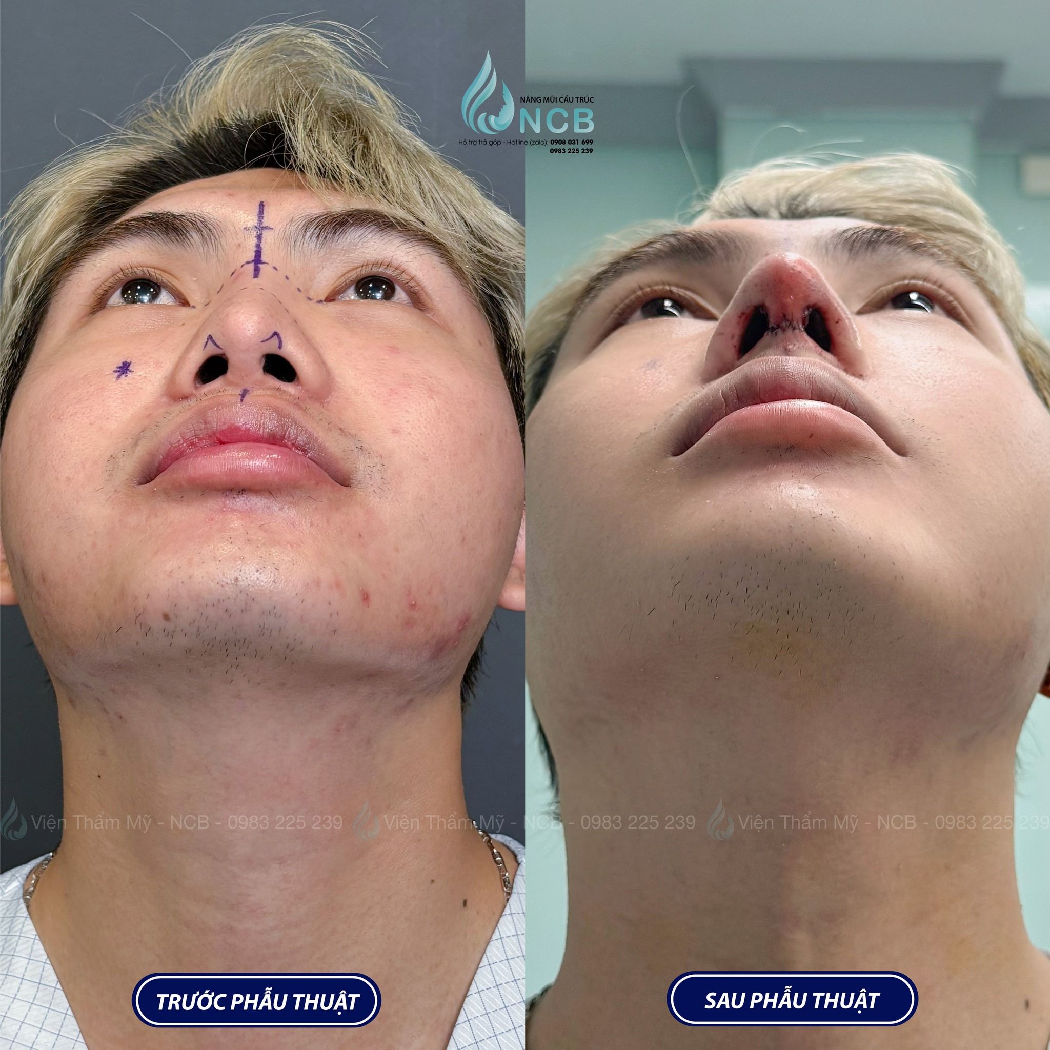 nghĩa một lít son nâng mũi