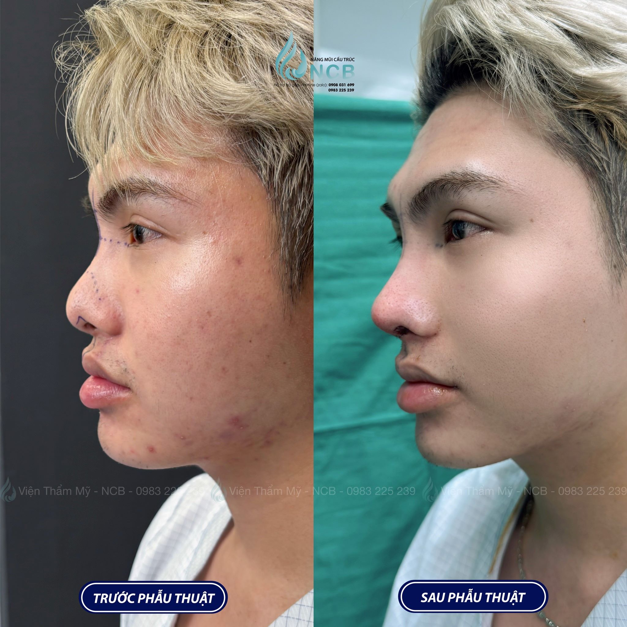 nghĩa một lít son nâng mũi tại ncb