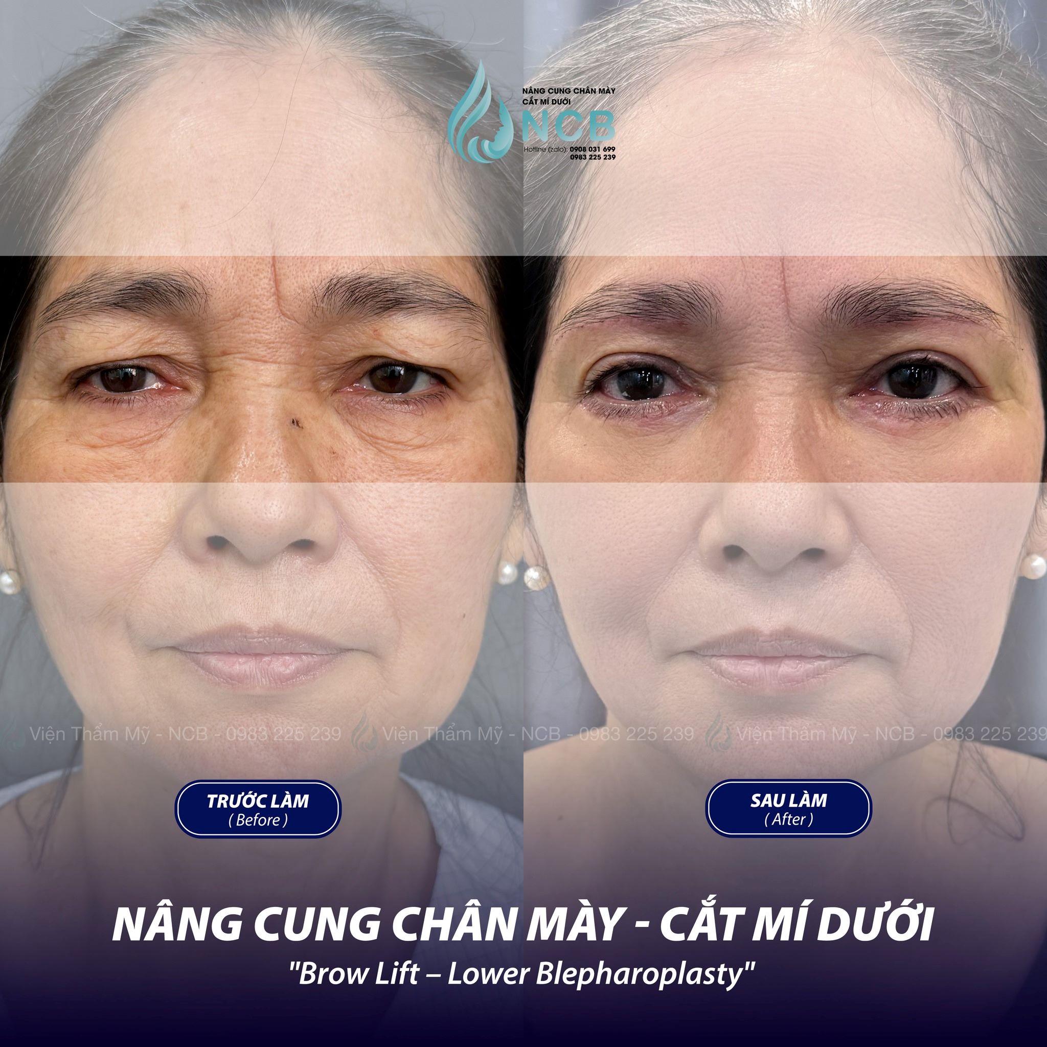 nâng cung chân mày 