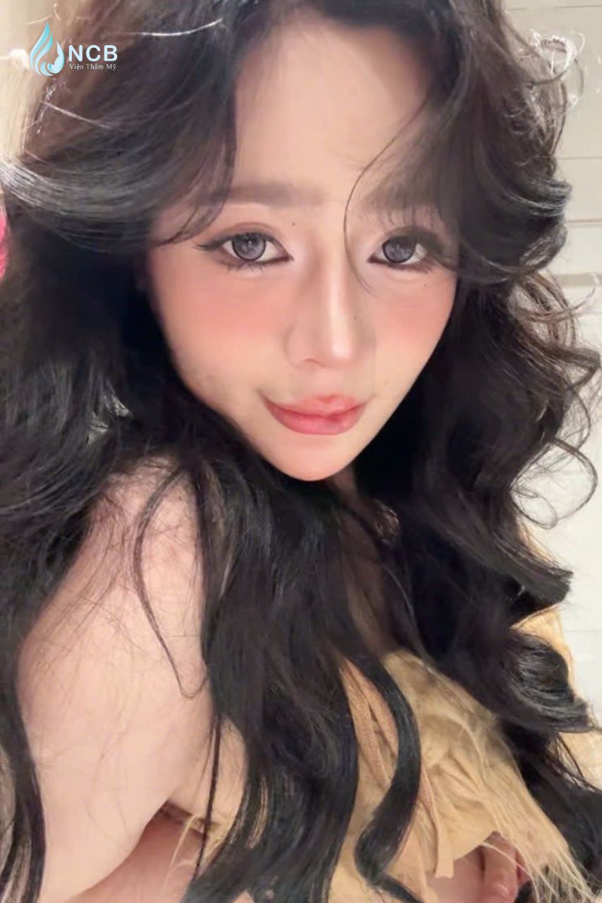 lâm nam phương nâng mũi