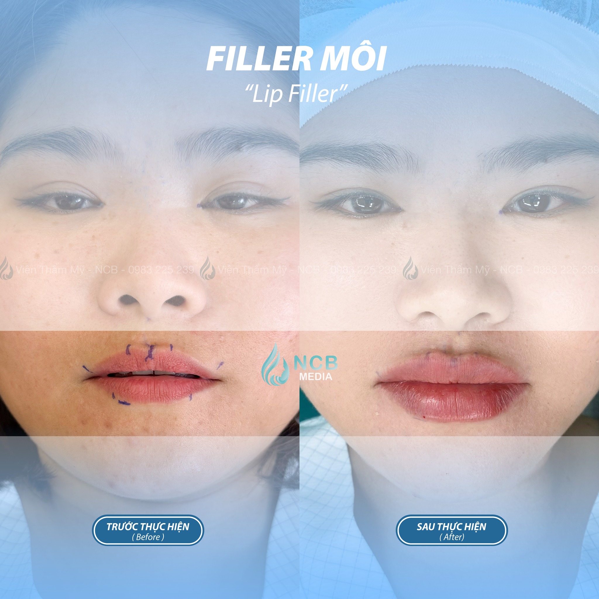 Tiêm filler môi