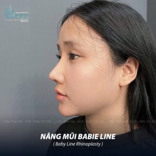 Việt Kiều Đức nâng mũi tại NCB
