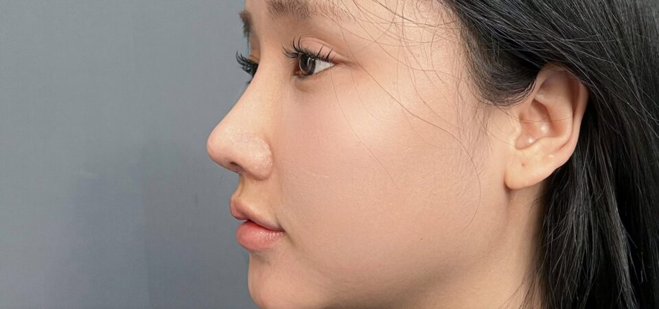 Việt Kiều Đức nâng mũi tại NCB