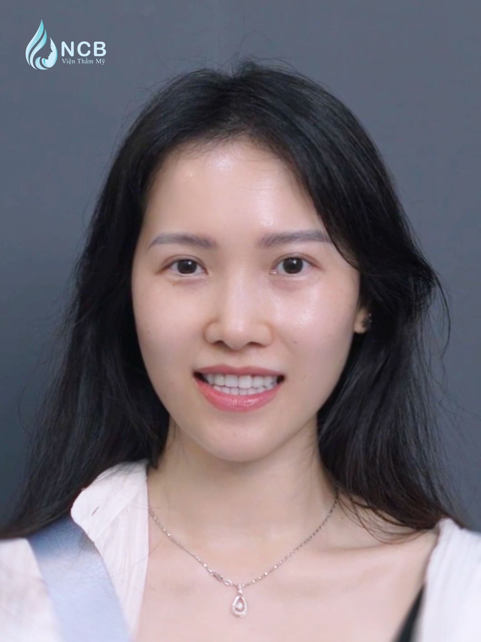 Việt Kiều Mỹ nâng mũi tại Việt Nam