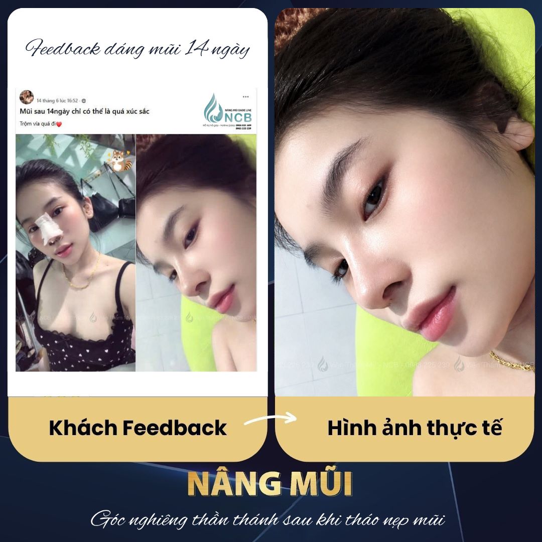 feedback nâng mũi tại NCB