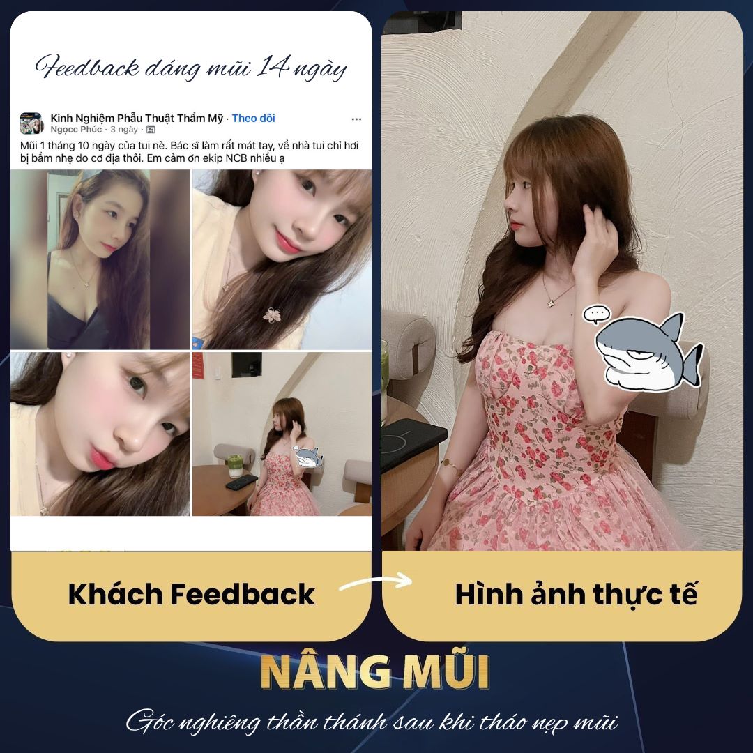 feedback nâng mũi tại NCB