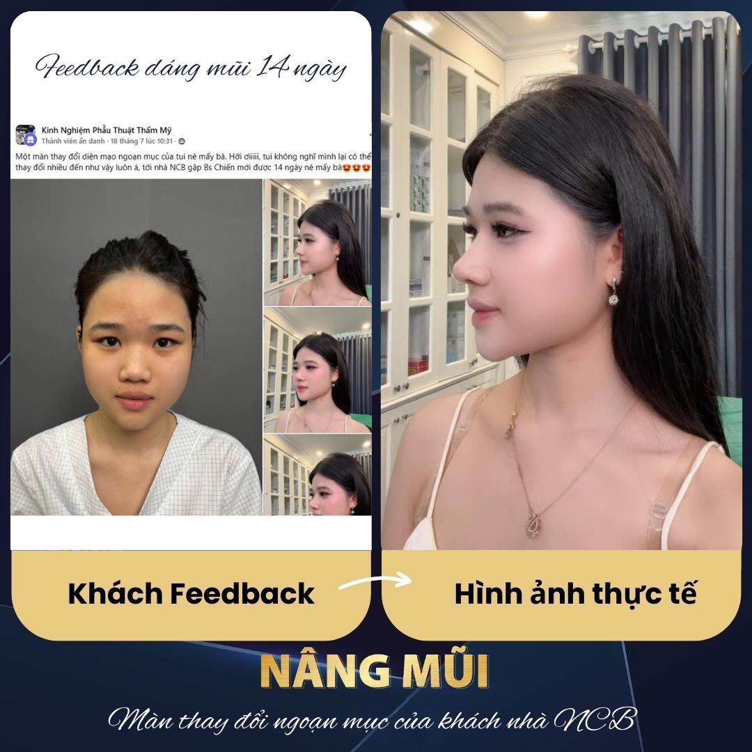 feedback nâng mũi tại NCB