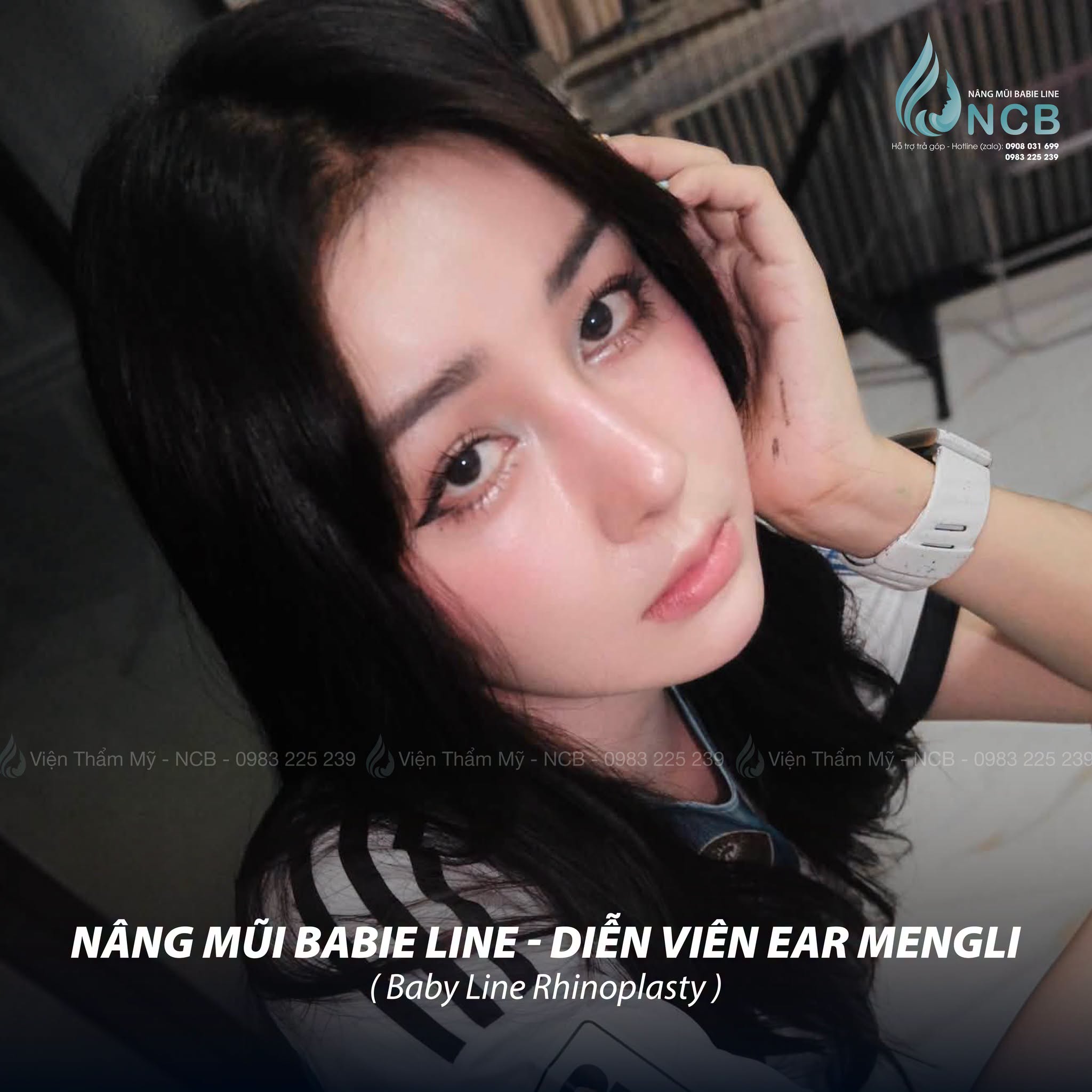 ear mengli sau nâng mũi