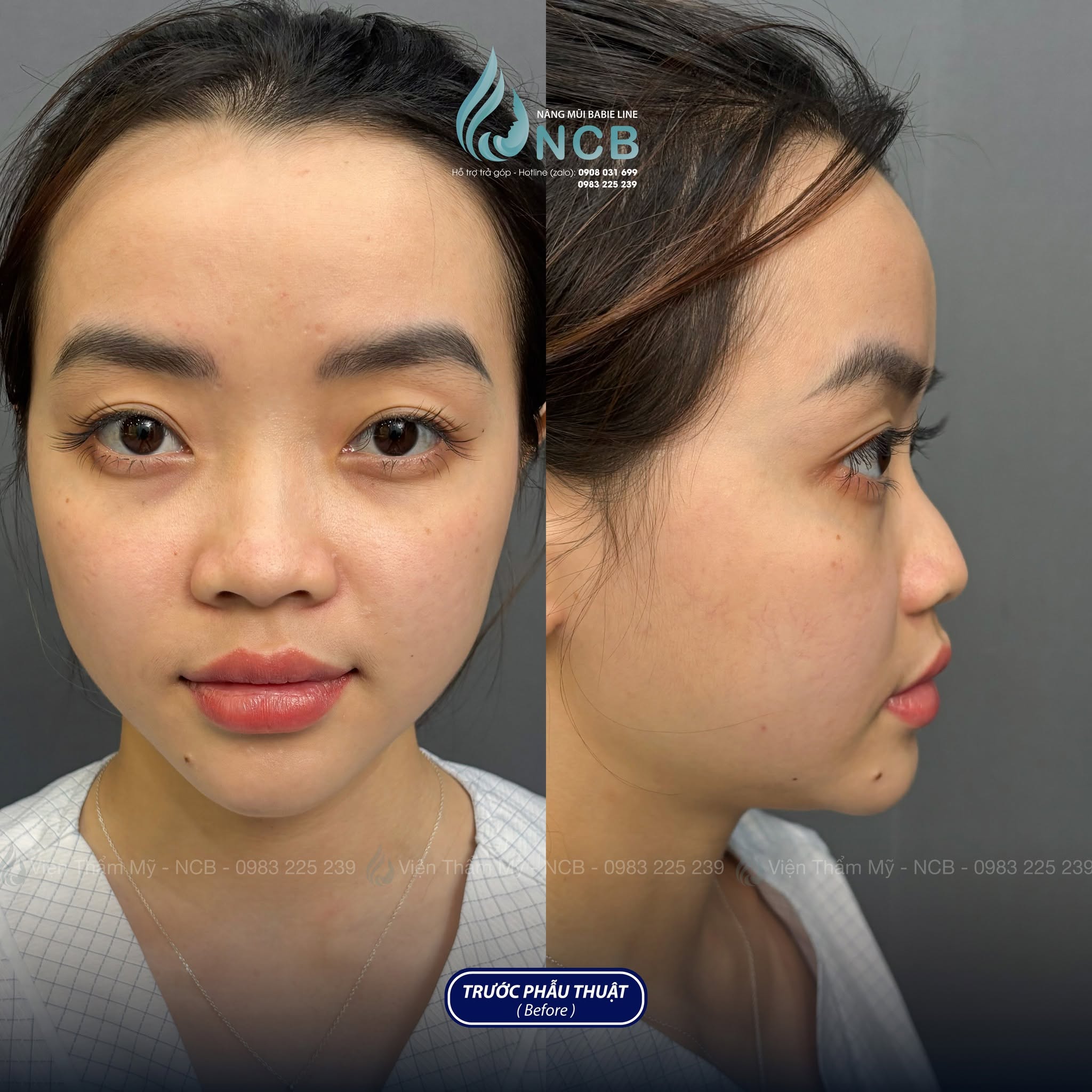 nâng mũi gồ tại ncb