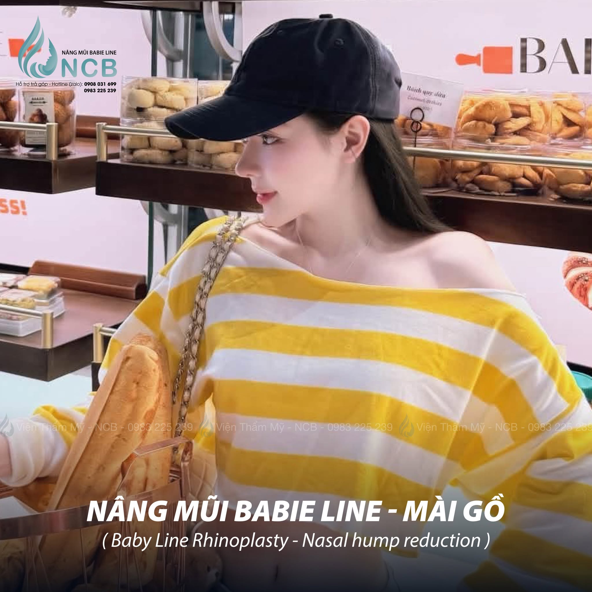 nâng mũi gồ tại NCB