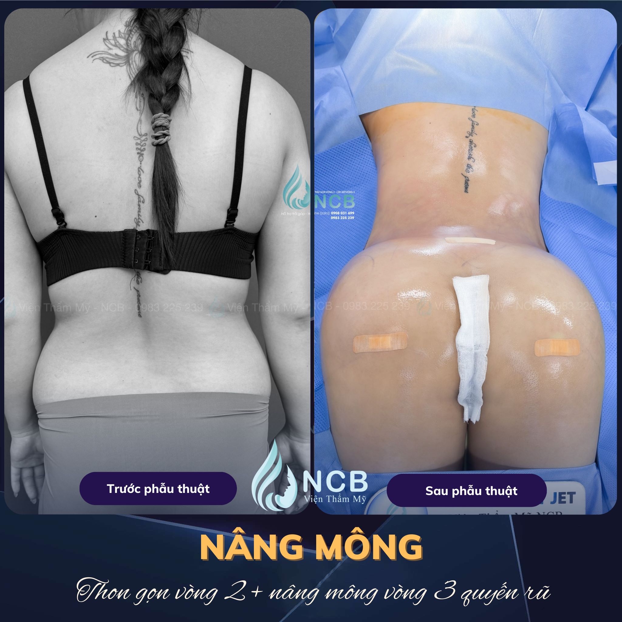 nâng mông bằng túi độn tại NCB