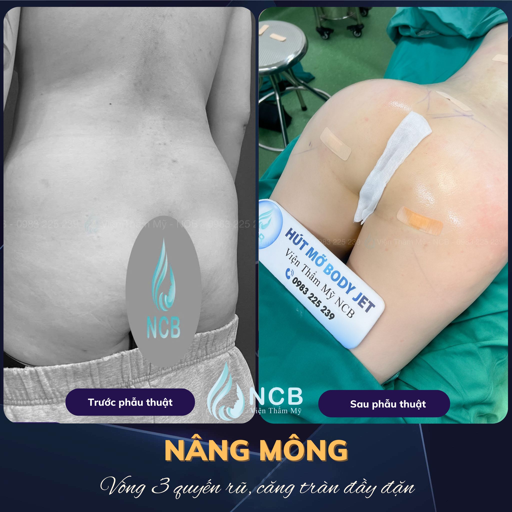 nâng vòng 3 bằng túi độn