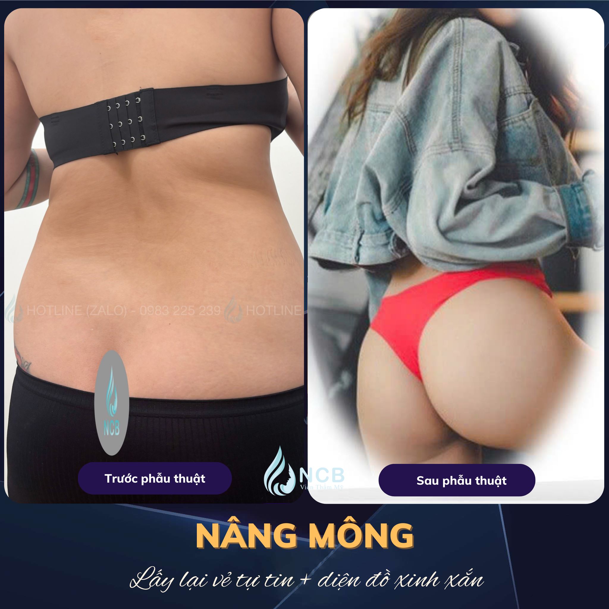nâng mông bằng túi độn