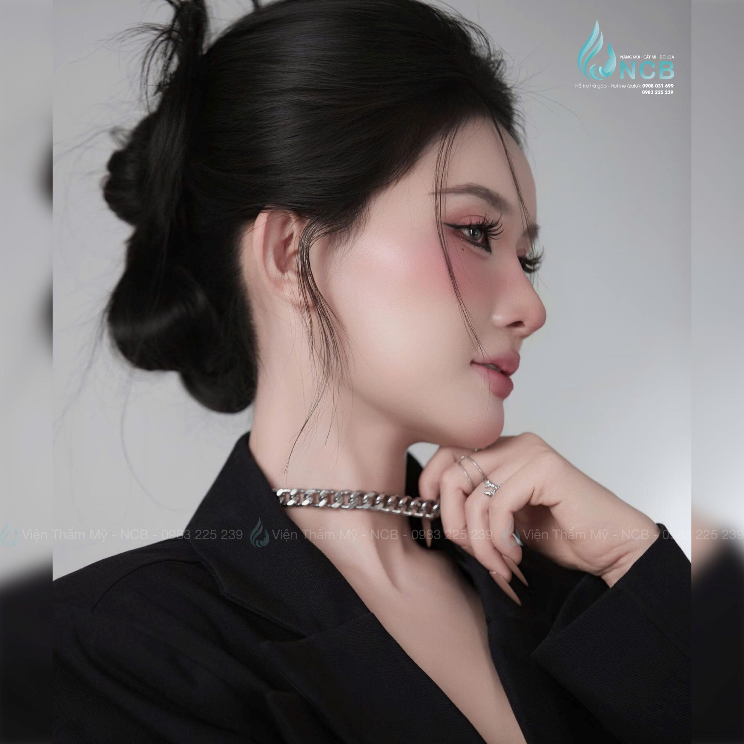 combo nâng mũi cắt mí tại Viện Thẩm Mỹ NCB